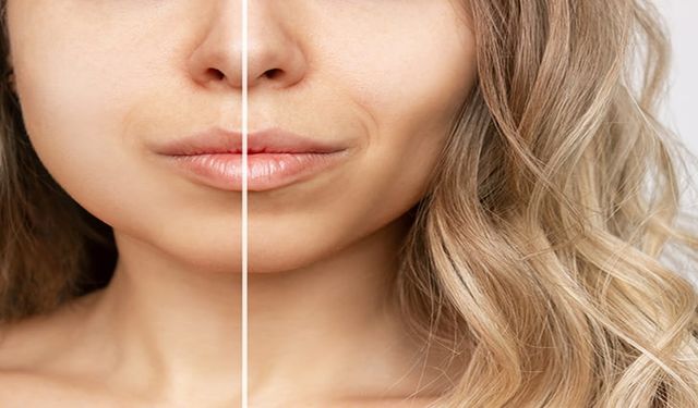 Bişektomi ile Hollywood Yanağı Trendine Siz de Katılın!